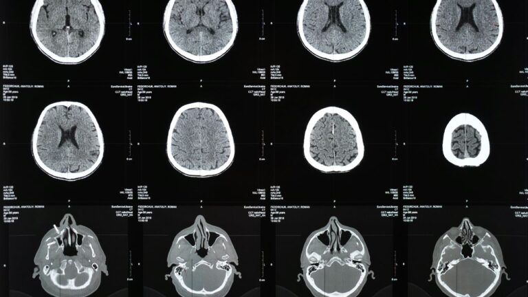 Brain Imaging in Mental Health Research