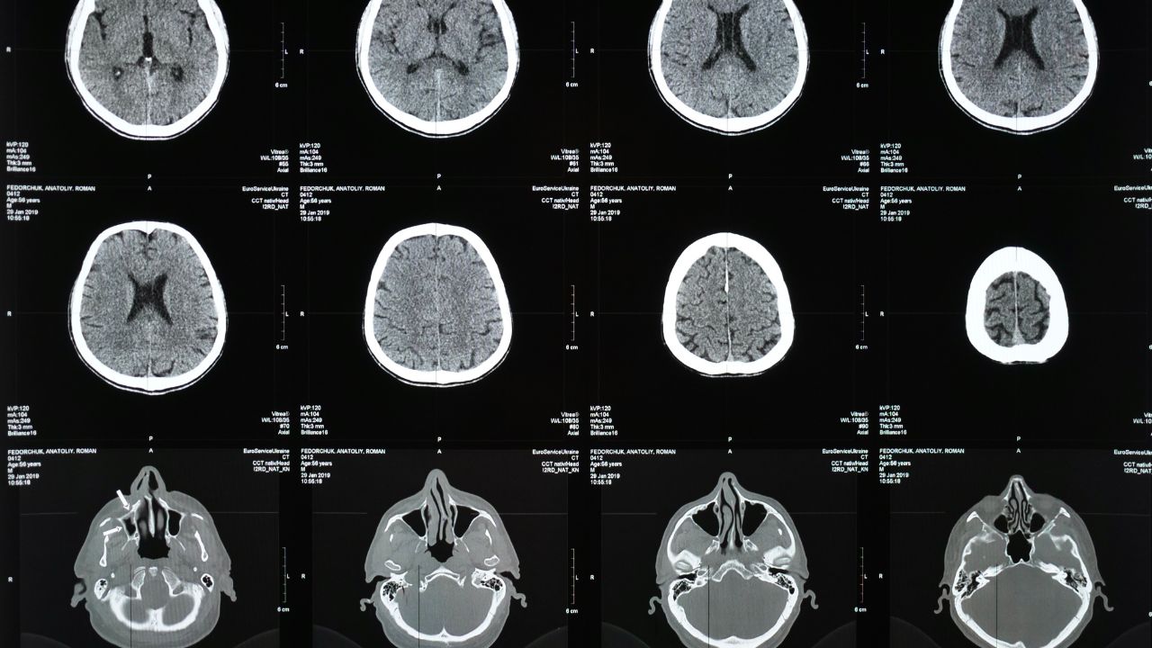 Brain Imaging in Mental Health Research